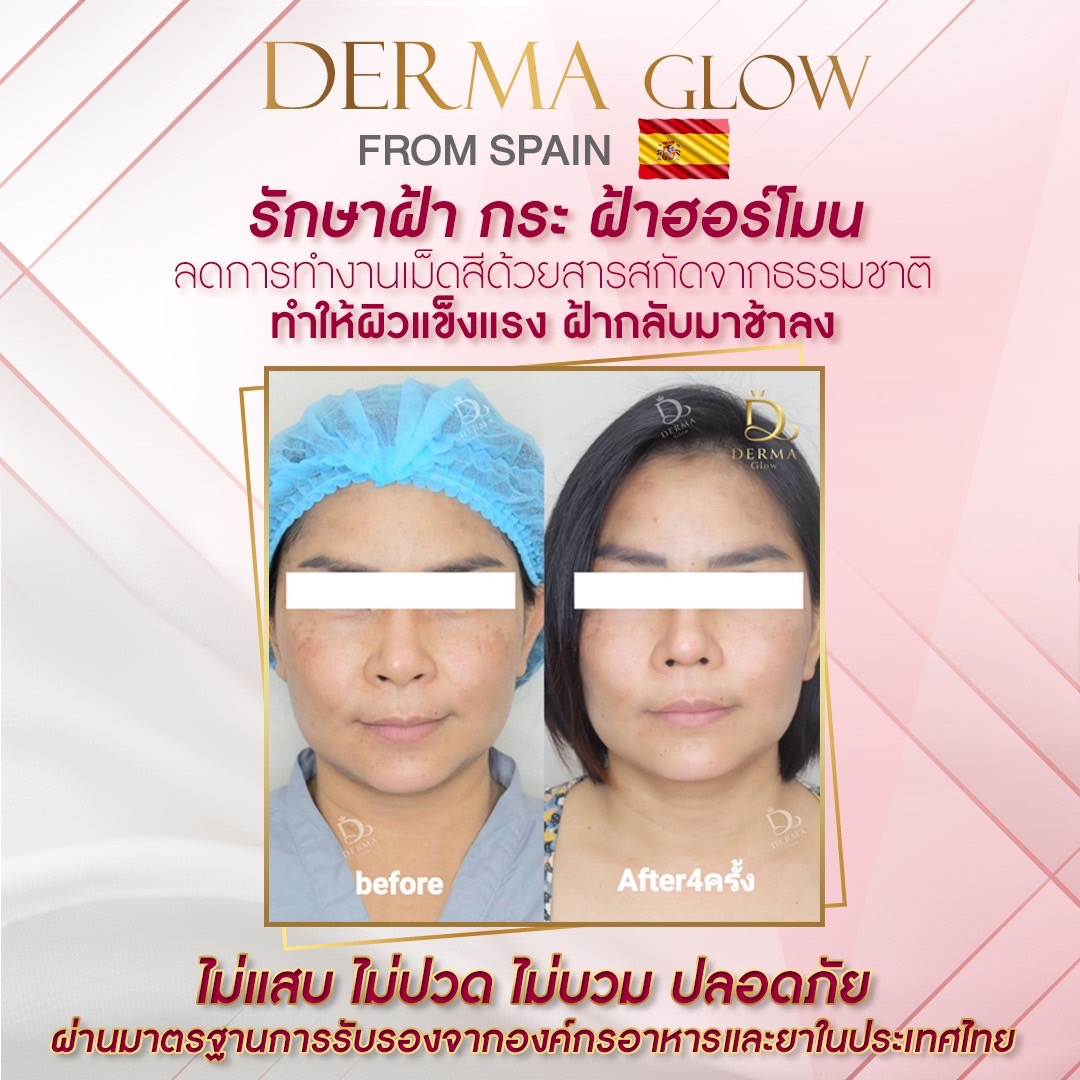 Derma Glow รักษากระ ได้อย่างไร?